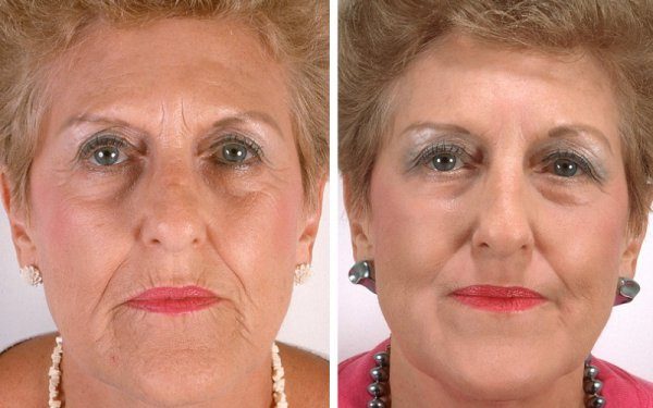 До и после нитевого лифтинга лица в зрелом возрасте