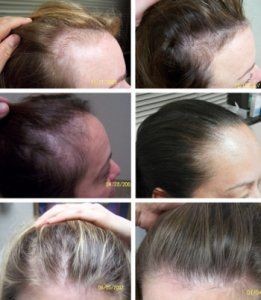 безоперационное лечение потери волос у женщин фото до и после