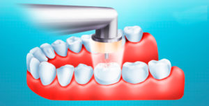 Озонотерапия используется и в стоматологии
