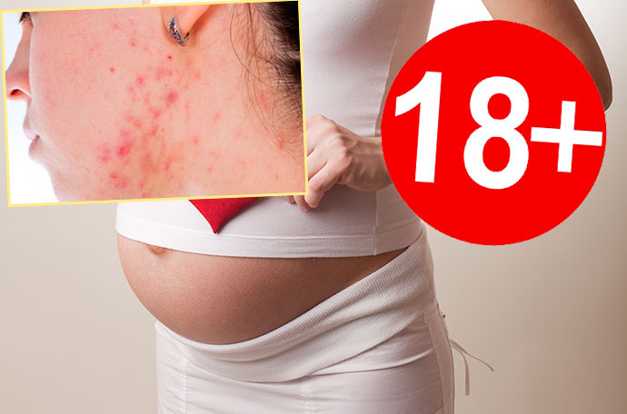 Воспаление кожи, беременность и возраст до 18