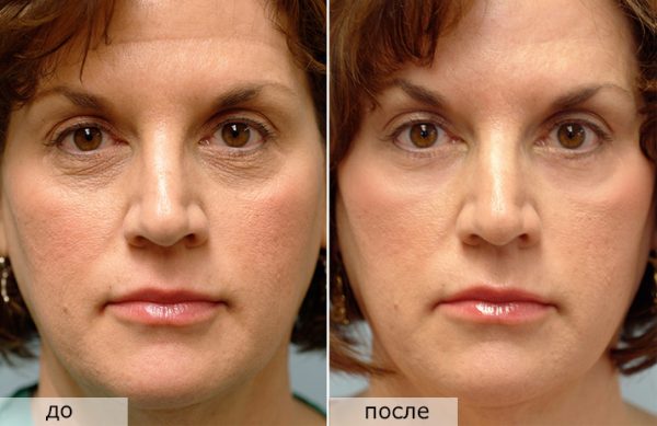 Фракционное лазерное омоложение лица: до и после