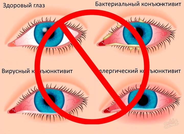 При заболеванияхз глаз противопоказано проведение блефаропластики