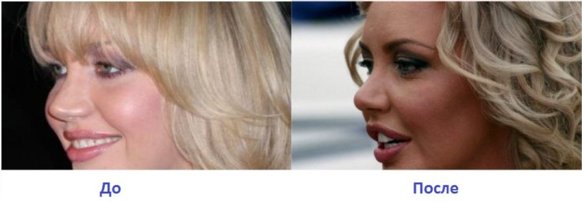пластика носа малиновской до и после