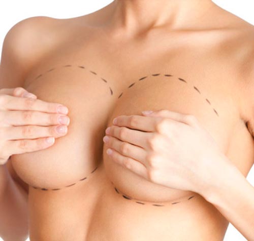 Мастопексия - хирургическая операция по подтяжке груди