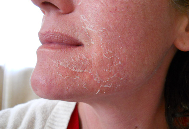 Шелушение кожи лица после пилинга