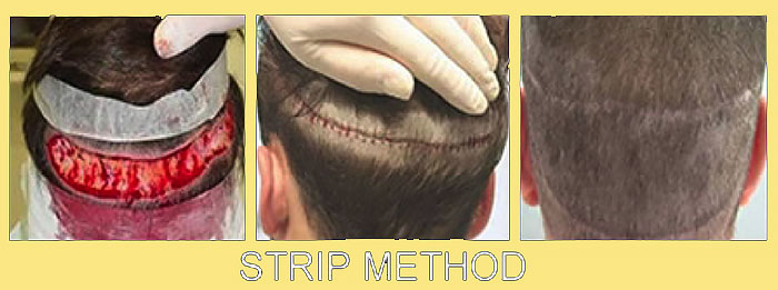 STRIP-метод пересадки волос