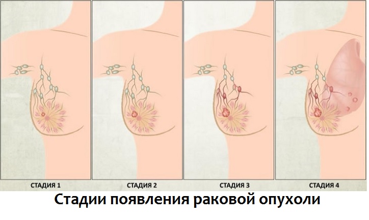 Появление рака груди