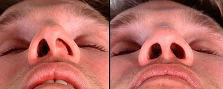 Кривая перегородка носа. Вид снизу