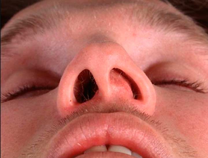 Отечность в носу при перфорации носовой перегородки