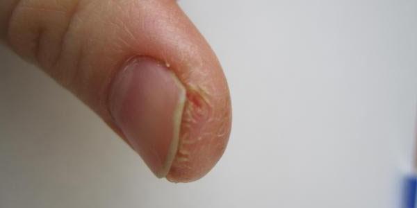 Трескается кожа на пальцах рук около ногтей: причины, лечение и профилактика