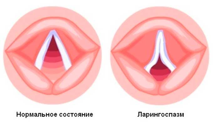 Ларингоспазм вследствие несвоевременного лечения перфорации носовых перегородок