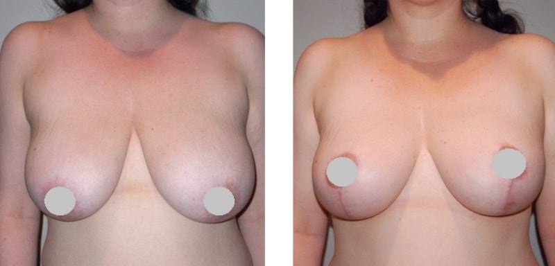 Подтяжка грудных желез без имплантов до и после