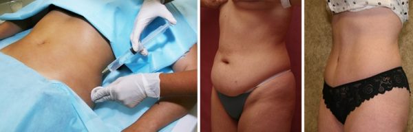 Процедура мезотерапии, фото до и после