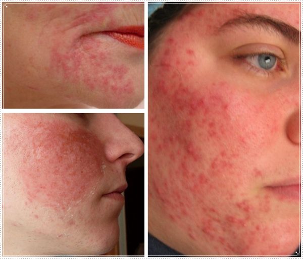 Примеры аллергии на лице