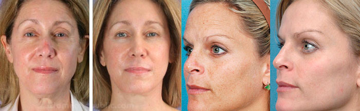 Эффект плазмолифтинга, вид лица до и после