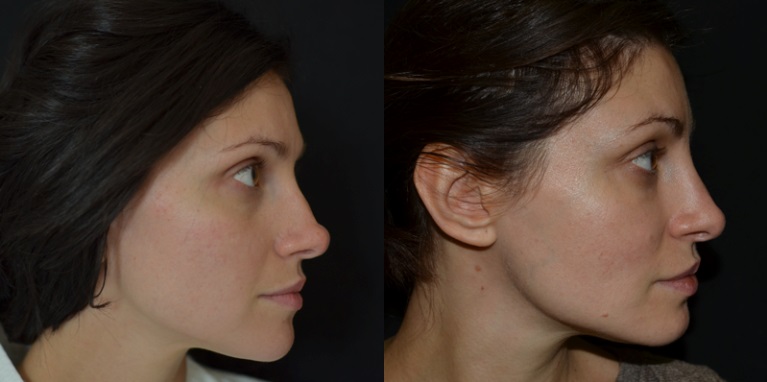 До и после ринопластики кончика носа