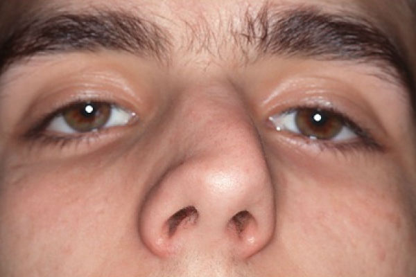 Деформация носа после ринопластики