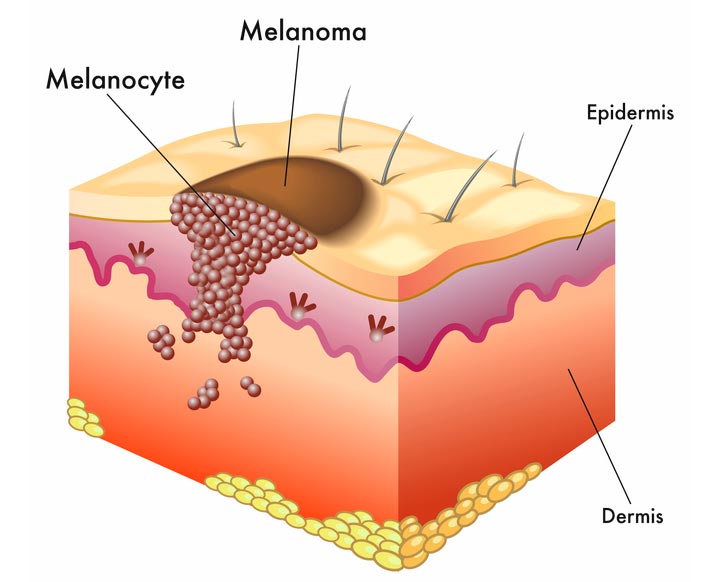 Схема меланомы