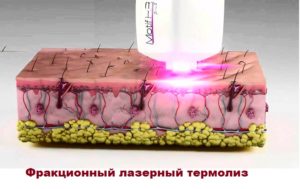 Схема фракционного лазерного влияния на кожу