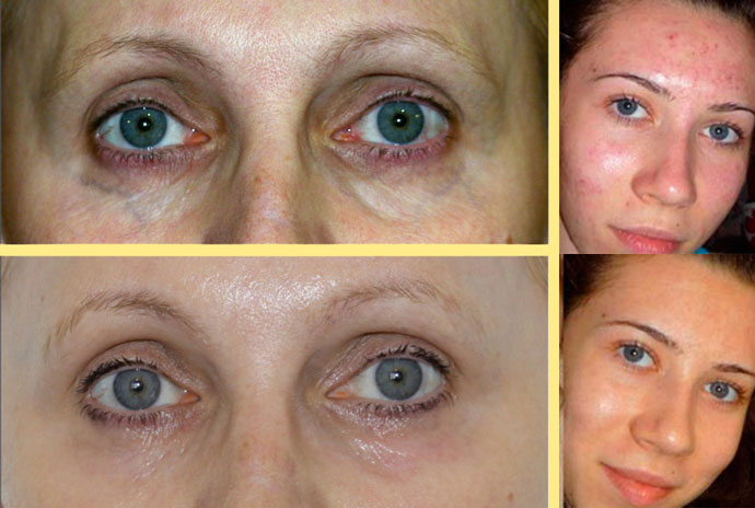 Кореркция проблем кожи плазмолифтиногом, до и после