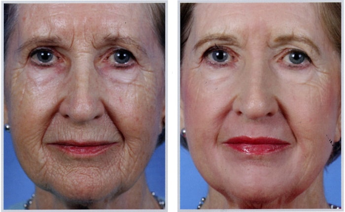 лазерное омоложение лица до и после