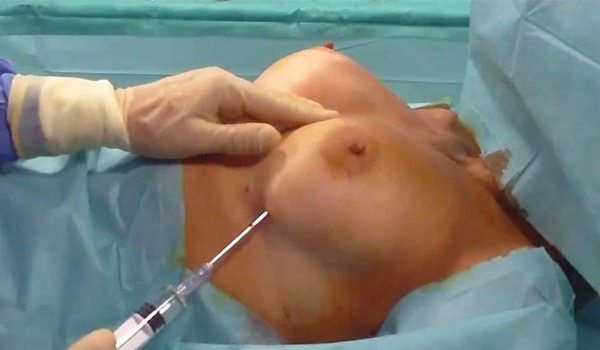 Подтяжка грудных желез без имплантов филлерами