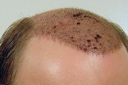 Сколько стоит пересадка волос на голове