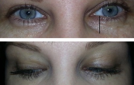 Результат устранения синяков под глазами от пользователя Маська91