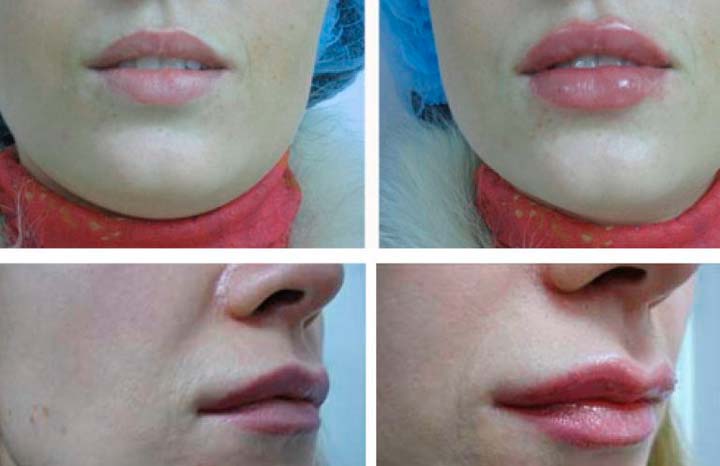 Результат липофилинга губ