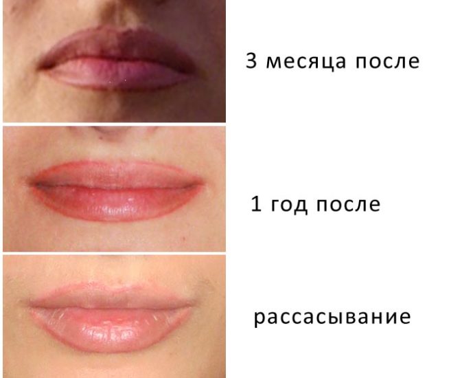 осложнения после перманентного макияжа губ