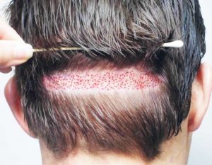 лоскутный метод пересадки волос