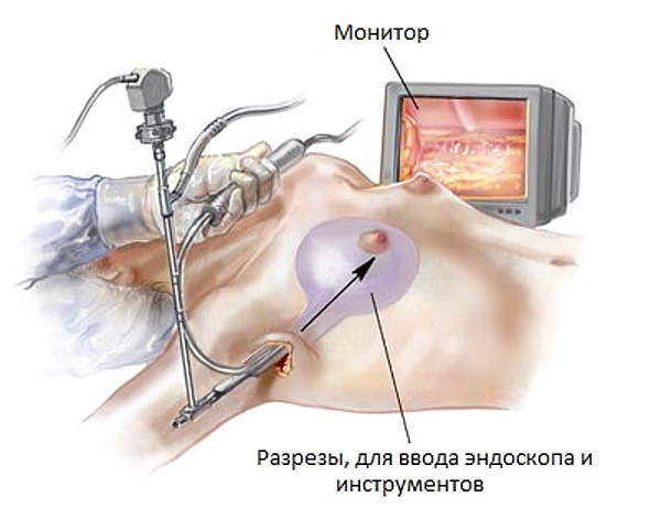 Эндоскопическое увеличение груди двухплоскостным методом