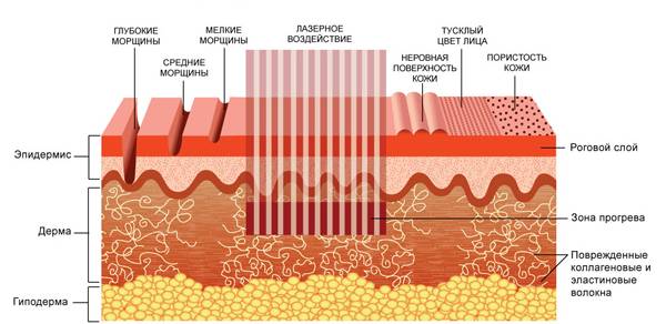 принцип действия лазера на кожу