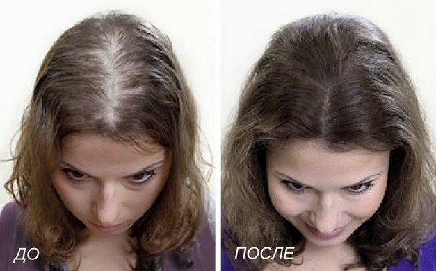 аппаратная косметология увеличение густоты волос