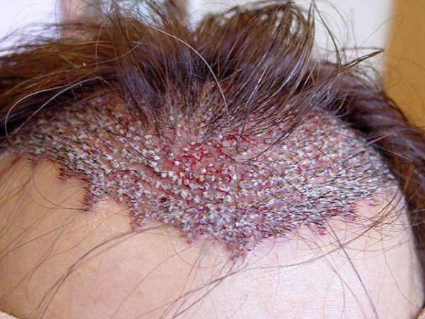 Вид головы пациента сразу после пересадки волос методом HFE