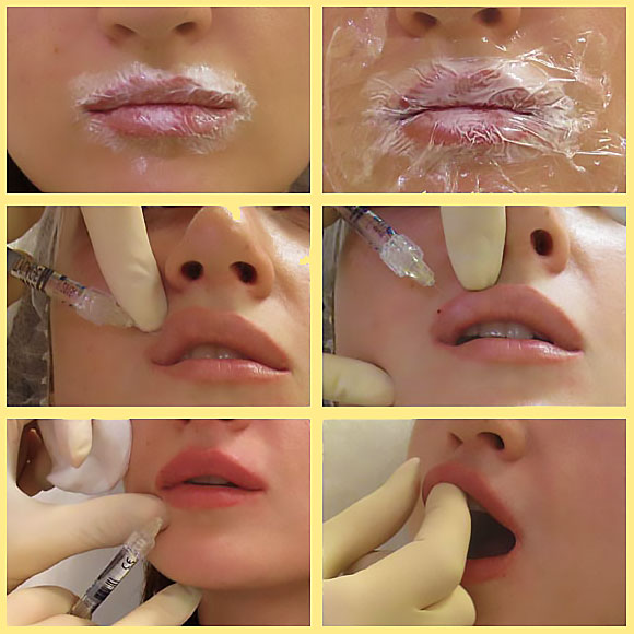 Этапы коррекции губ гиалуроновой кислотой