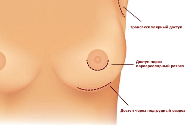 Эндоскопическое увеличение груди анатомическими имплантами natrelle