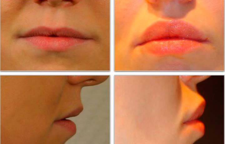 Результат хейлопластики губ