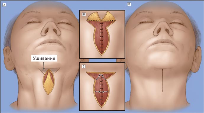Схема хирургической подтяжки шеи 