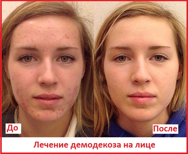 демодекс на лице до и после