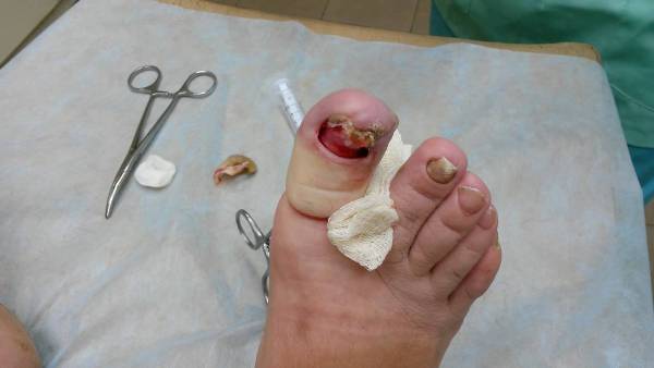 Операция по удалению вросшего ногтя на ноге