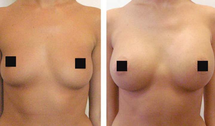 Фото 3 до и после изменения груди
