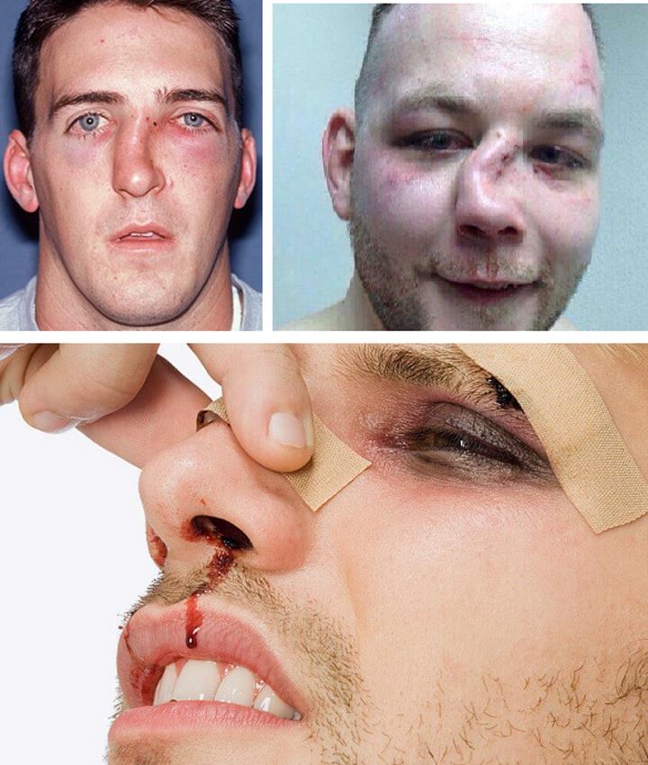 Последствия травм носа