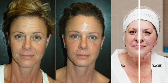 Ультразвуковая подтяжка лица до и после