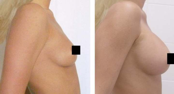 До и после увеличения груди