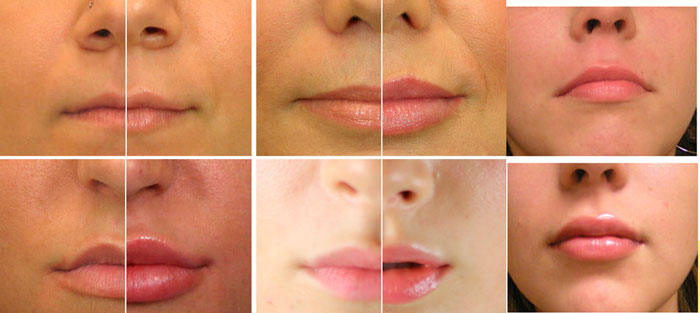 Эффекты корекции губ до и после уколов гиаулороновой кислоты