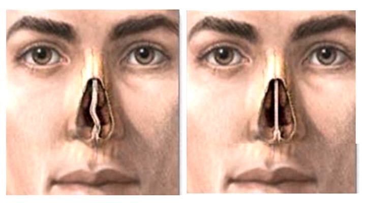 Нос с кривой и прямой перегородками в разрезе