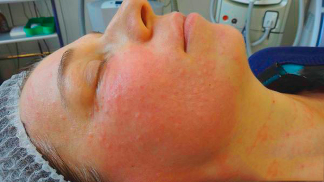 Аллергическая реакция кожи после биоревитализации