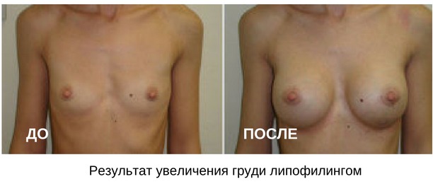 липофилинг груди