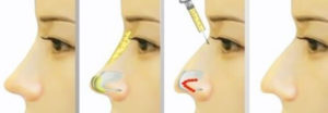 Ринопластика горбинки носа